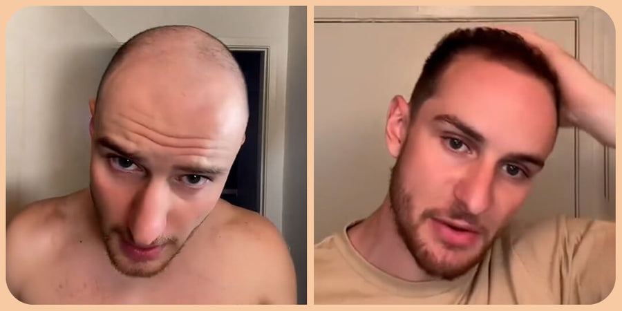 đ„đ„Gyors hajnövekedĂ©s keverĂ©k đ„đ„đ HatĂ©kony kezelĂ©s a hajhullĂĄsra Növelje a haj mennyisĂ©gĂ©t gyorsanđ