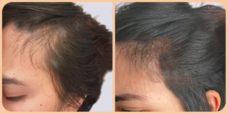 đ„đ„Gyors hajnövekedĂ©s keverĂ©k đ„đ„đ HatĂ©kony kezelĂ©s a hajhullĂĄsra Növelje a haj mennyisĂ©gĂ©t gyorsanđ